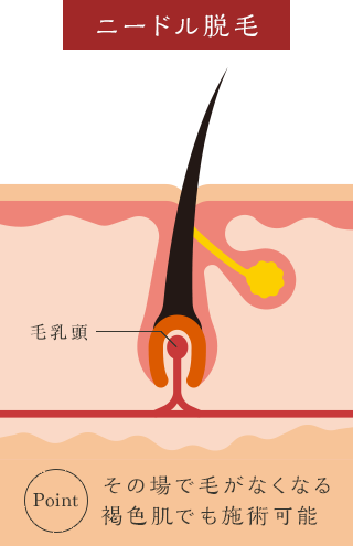 ニードル脱毛