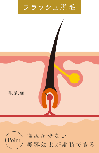 フラッシュ脱毛